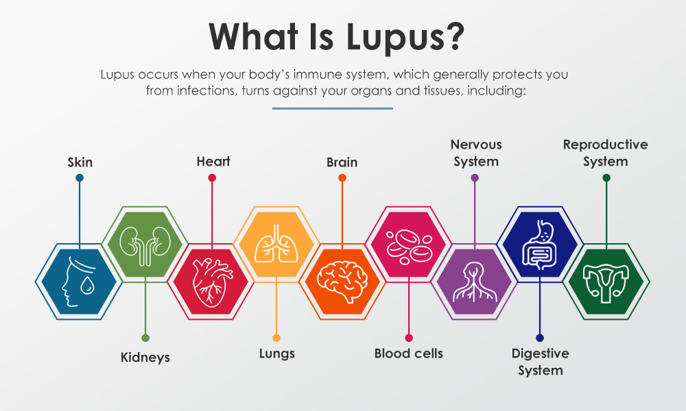 Is Lupus A Disability